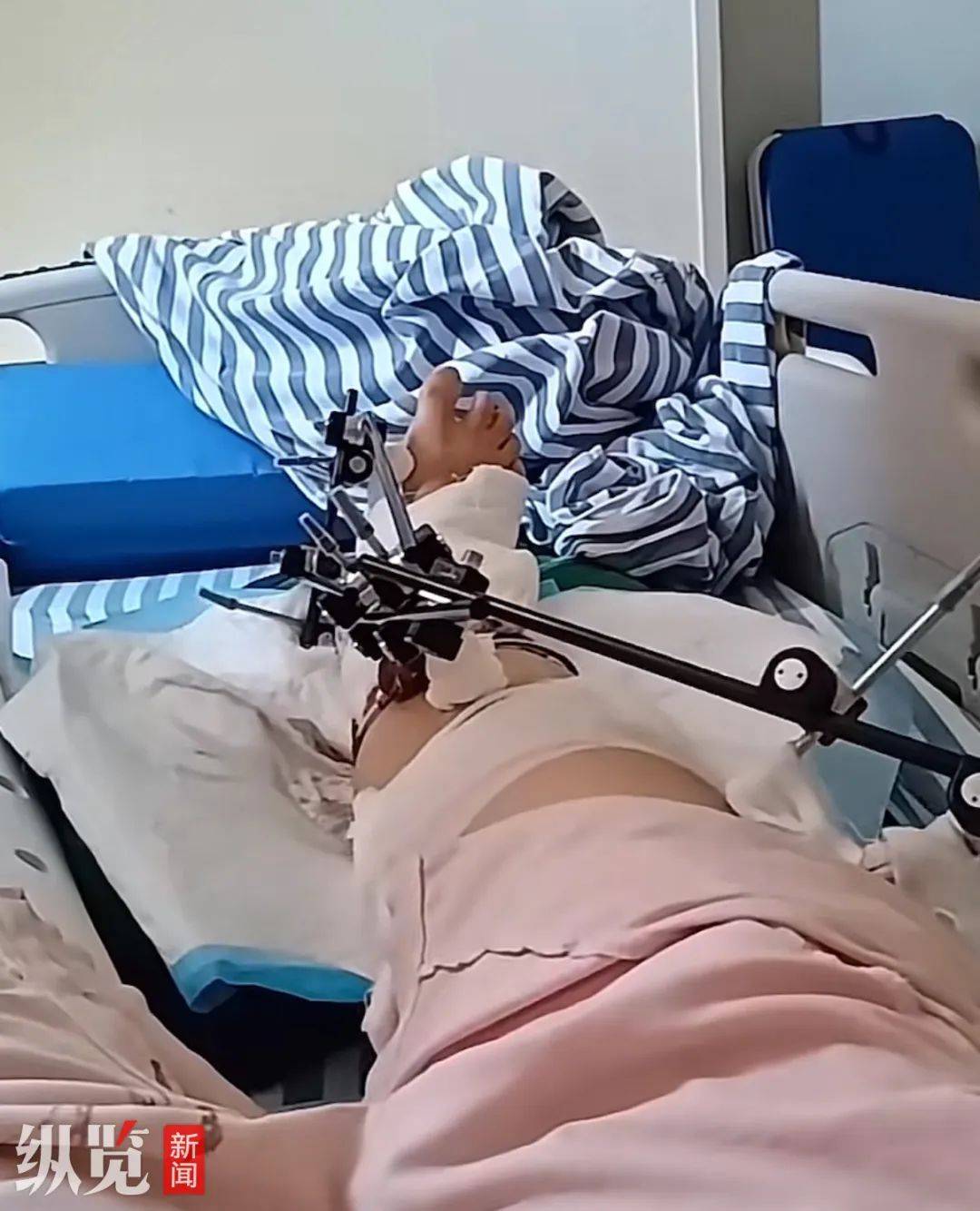 江西一女子从12楼坠落奇迹生还!当事人还原细节:即将落地时先接触到车棚,若第二次手术成功,半年后就可恢复正常